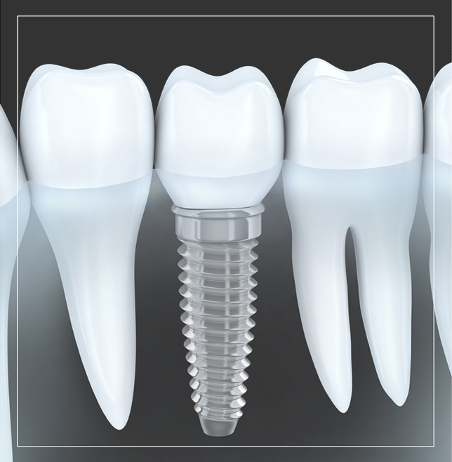 Dental Implants in Mattoon, IL